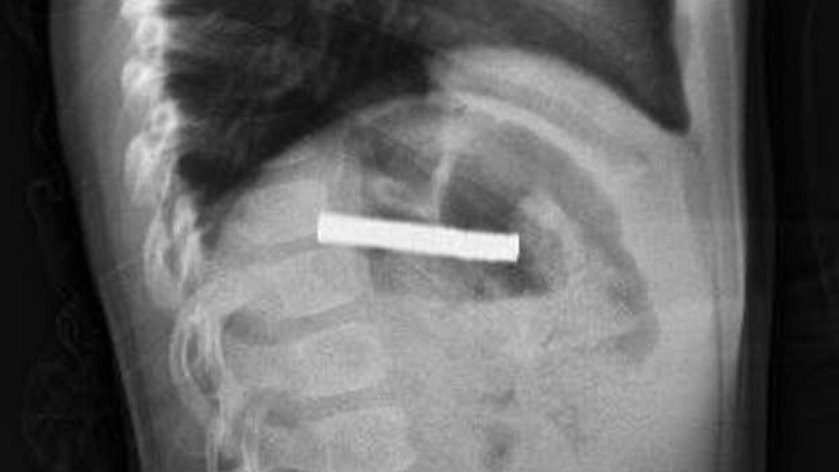 elazigda cocugun bogazindan 19 adet miknatis cikartildi XLxFK7kO