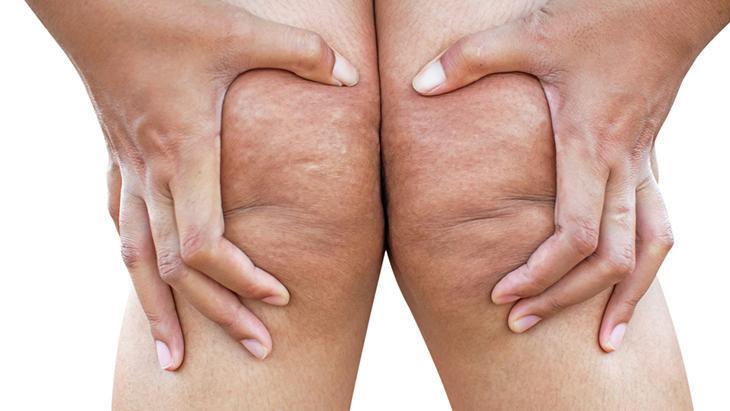 lipodem kadinlarin sessiz cigligi neden kilo veremiyorum diyenler icin cevap gvvamRzx.jpg